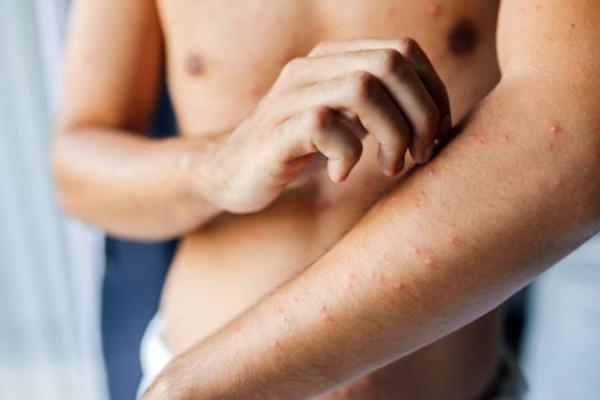 Mpox viruela símica OMS
