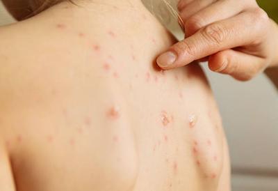 OMS alerta emergencia sanitaria por brote de mpox